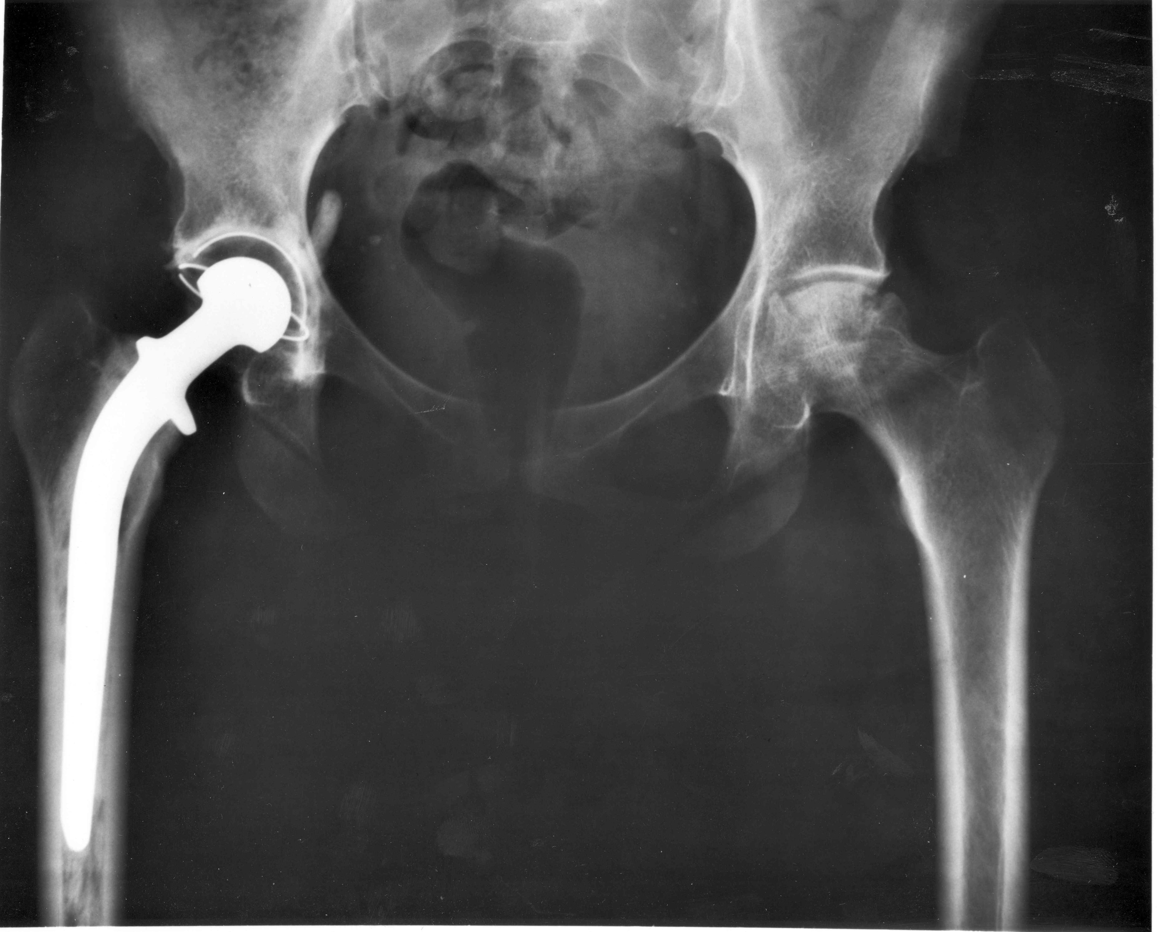 An anteroposterior pelvic X-ray showing a total hip replacement, with the metal femoral stem and prosthetic head visible.