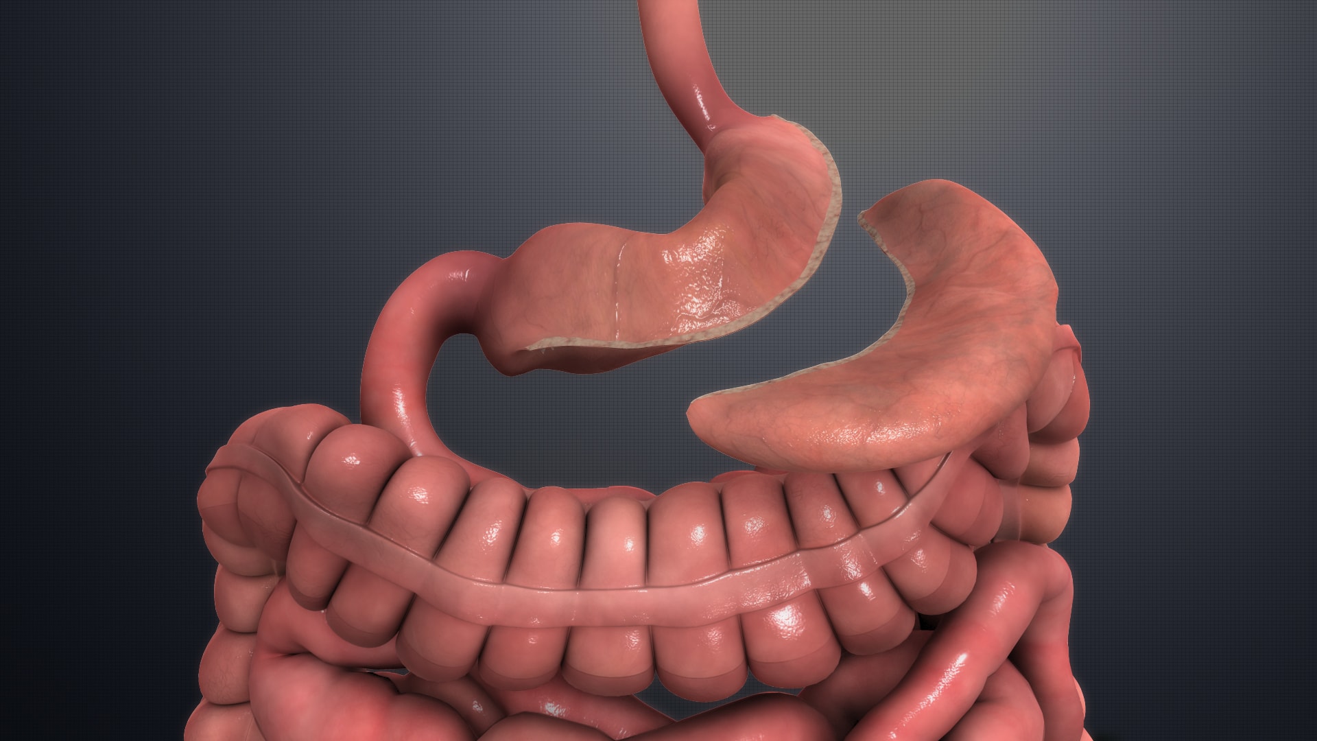 Medical illustration of a sleeve gastrectomy, showing the stomach reduced to a narrow sleeve.